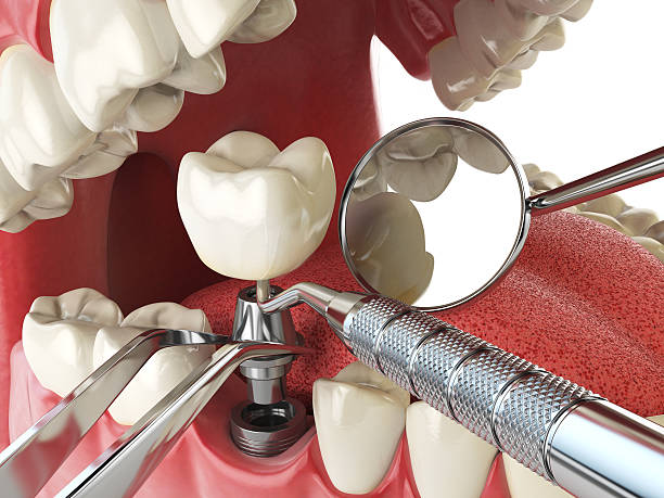 Best Emergency Wisdom Teeth Removal in Stonewall, MS